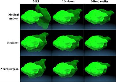 Comparing the influence of mixed reality, a 3D viewer, and MRI on the spatial understanding of brain tumours